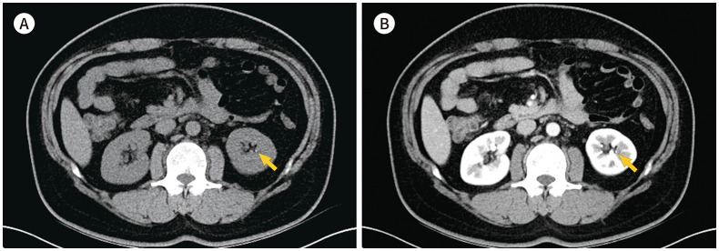 Usefulness of Corticomedullary-Phase CT Urography in Patients with Suspected Acute Renal Colic Visiting the Emergency Department.