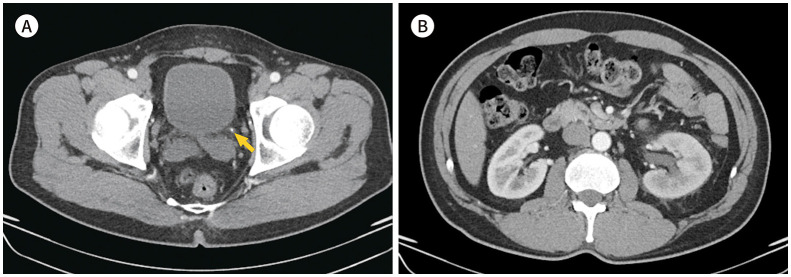 Usefulness of Corticomedullary-Phase CT Urography in Patients with Suspected Acute Renal Colic Visiting the Emergency Department.