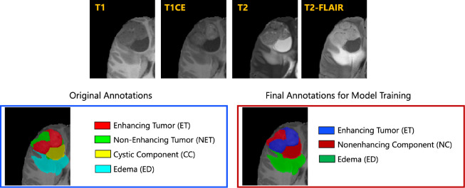 The Brain Tumor Segmentation (BraTS) Challenge 2023: <i>Focus on Pediatrics (CBTN-CONNECT-DIPGR-ASNR-MICCAI BraTS-PEDs)</i>.