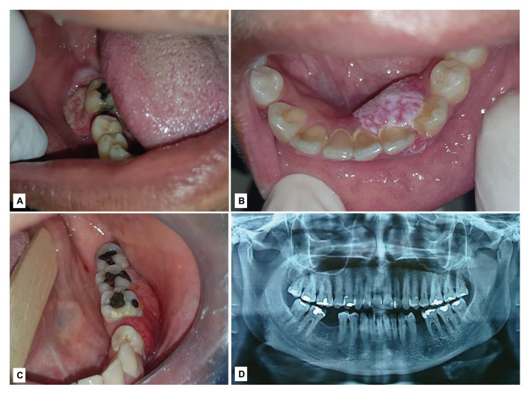 Gingival neoplasms: a multicenter collaborative study of 888 patients in Brazil.