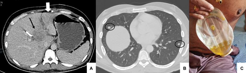 Combined Bile Duct Ablation and Fistulous Tract Embolization Using N-Butyl Cyanoacrylate to Manage a Biliary-Cutaneous Fistula Following Percutaneous Transhepatic Biliary Drainage (PTBD) for Hilar Cholangiocarcinoma.