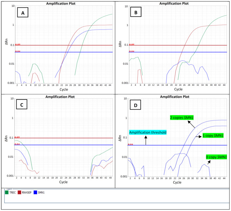 Alberta Spinal Muscular Atrophy Newborn Screening-Results from Year 1 Pilot Project.