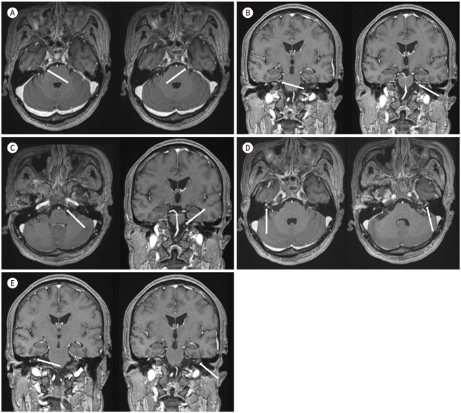 MRI Features of Multiple Cranial Neuropathies in Guillain-Barré Syndrome Occurring after COVID-19 Vaccination: A Case Report.