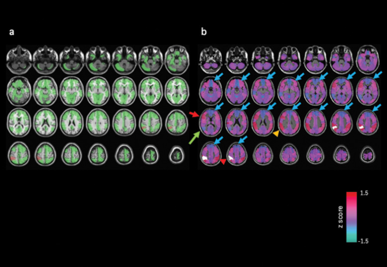 Functional Connectivity Pattern Using Resting-state fMRI as an Assessment Tool for Spatial Neglect during the Recovery Stage of Stroke: A Pilot Study.