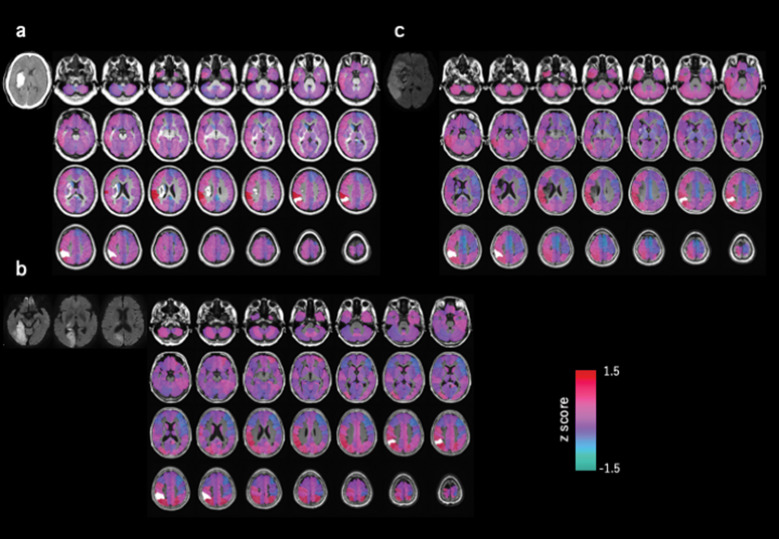 Functional Connectivity Pattern Using Resting-state fMRI as an Assessment Tool for Spatial Neglect during the Recovery Stage of Stroke: A Pilot Study.