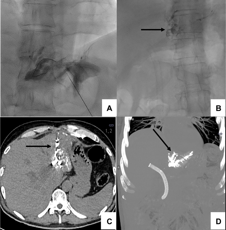 Combined Bile Duct Ablation and Fistulous Tract Embolization Using N-Butyl Cyanoacrylate to Manage a Biliary-Cutaneous Fistula Following Percutaneous Transhepatic Biliary Drainage (PTBD) for Hilar Cholangiocarcinoma.