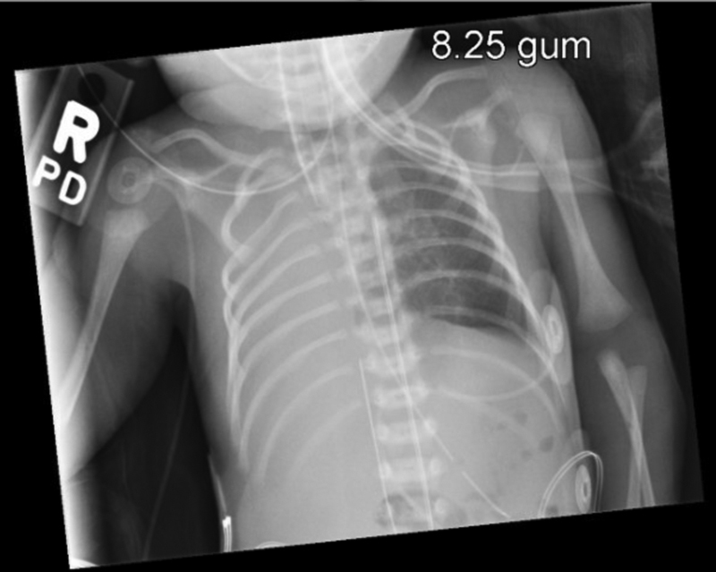 Unilateral Lung Agenesis: A Case Series and Review of Literature.