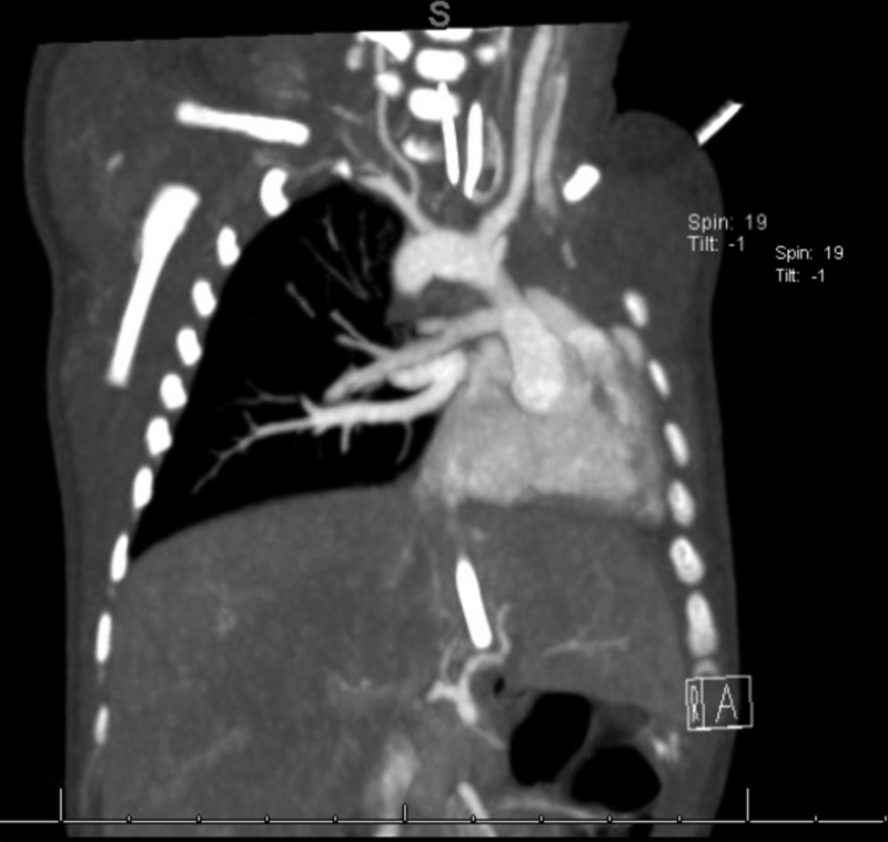 Unilateral Lung Agenesis: A Case Series and Review of Literature.