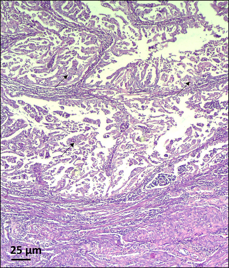 Lynch-like syndrome with germline WRN mutation in Bulgarian patient with synchronous endometrial and ovarian cancer.