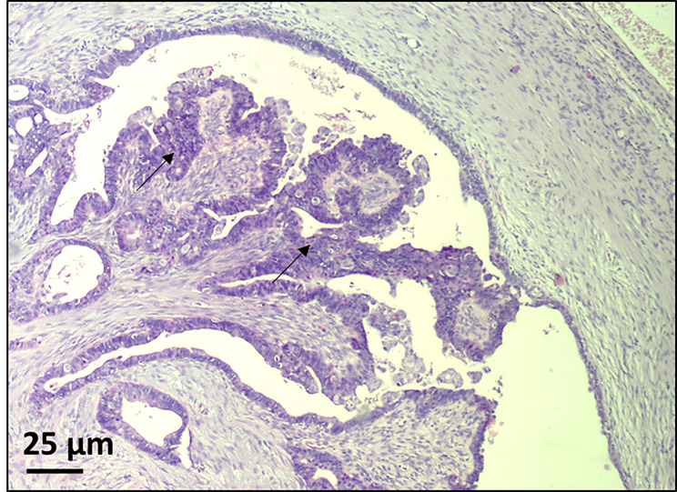 Lynch-like syndrome with germline WRN mutation in Bulgarian patient with synchronous endometrial and ovarian cancer.