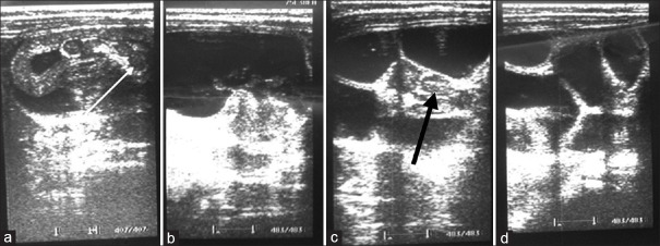 Management of intussusception in children: A comparative study of hydrostatic reduction with saline under ultrasound guidance versus laparoscopic assistance.