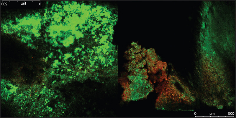 Antibiofilm activity of ultrasonic and diode laser activated sodium hypochlorite, chitosan, and chlorhexidine: A confocal laser scanning microscopic <i>in vitro</i> study.