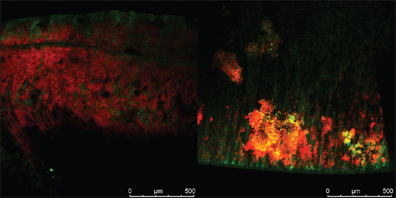 Antibiofilm activity of ultrasonic and diode laser activated sodium hypochlorite, chitosan, and chlorhexidine: A confocal laser scanning microscopic <i>in vitro</i> study.