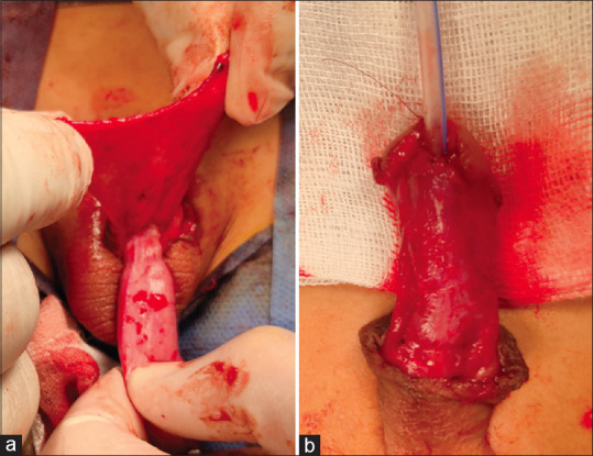 Dorsal inlay inner preputial graft repair versus ventral-only preputial graft repair in primary distal penile hypospadias with narrow urethral plate.