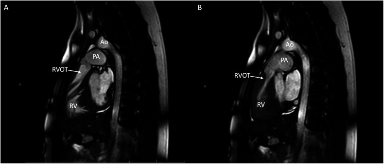 Managing Myocardial Bridge and Right Ventricular Outflow Tract Obstruction in an Adolescent With Hypertrophic Cardiomyopathy.