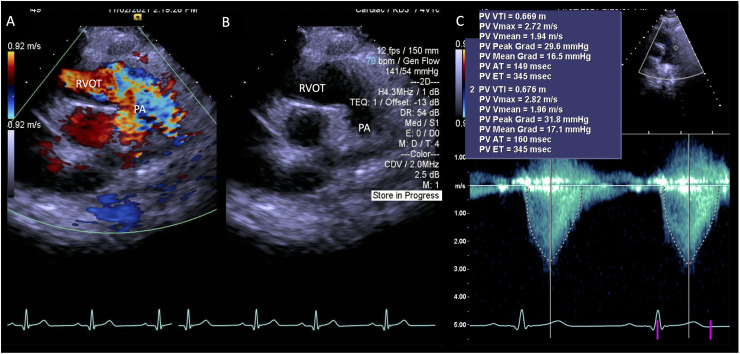 Managing Myocardial Bridge and Right Ventricular Outflow Tract Obstruction in an Adolescent With Hypertrophic Cardiomyopathy.