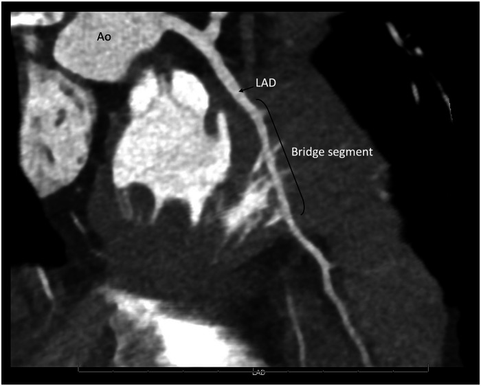 Managing Myocardial Bridge and Right Ventricular Outflow Tract Obstruction in an Adolescent With Hypertrophic Cardiomyopathy.