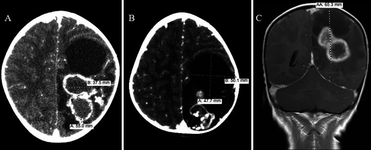 Pediatric intracranial tuberculoma: illustrative case.
