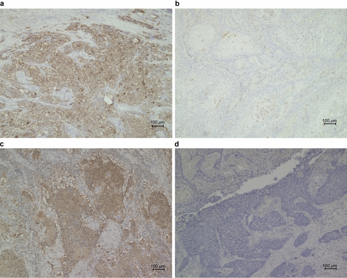 Simultaneous regulation of ferroptosis suppressor protein 1 and glutathione peroxidase 4 as a new therapeutic strategy of ferroptosis for esophageal squamous cell carcinoma.