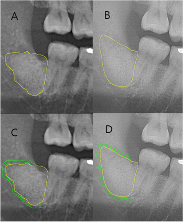 Efficacy of pure beta tricalcium phosphate graft in dentoalveolar surgery: a retrospective evaluation based on serial radiographic images.