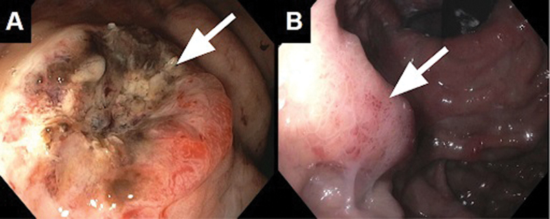 An Atypical Presentation of Hepatocellular Carcinoma with Multisite Metastasis following a Curative Liver Transplant.