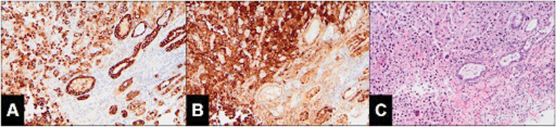 An Atypical Presentation of Hepatocellular Carcinoma with Multisite Metastasis following a Curative Liver Transplant.