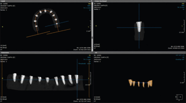 Comparative evaluation of the quality and homogeneity of different obturating systems using cone-beam computed tomography - An <i>in vitro</i> study.