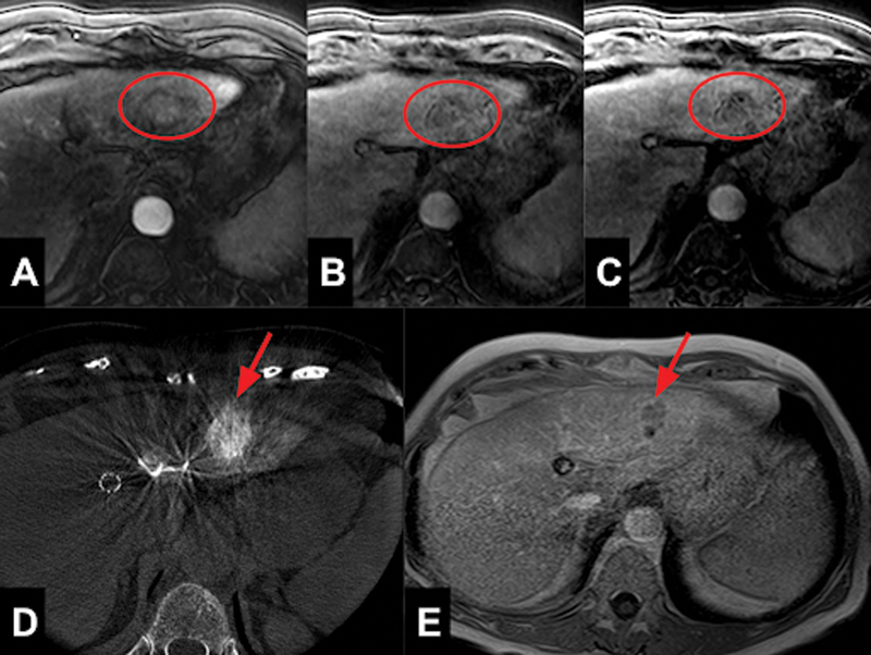 An Atypical Presentation of Hepatocellular Carcinoma with Multisite Metastasis following a Curative Liver Transplant.