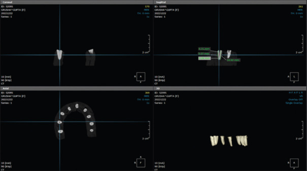 Comparative evaluation of the quality and homogeneity of different obturating systems using cone-beam computed tomography - An <i>in vitro</i> study.