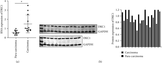 miRNA326-5p Targets DKC1 Gene to Regulate Apoptosis-Related Proteins and Intervene in the Development of Neuroblastoma.