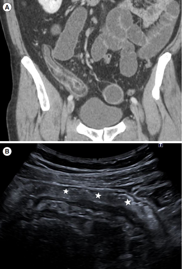 Submucosal fat accumulation in Crohn's disease: evaluation with sonography.