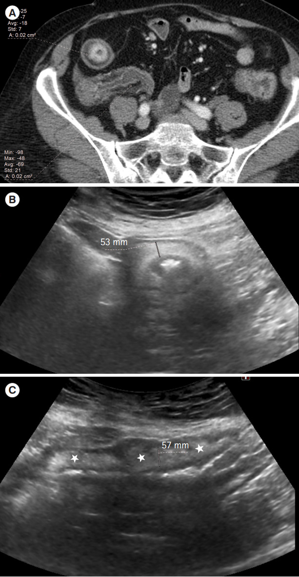 Submucosal fat accumulation in Crohn's disease: evaluation with sonography.