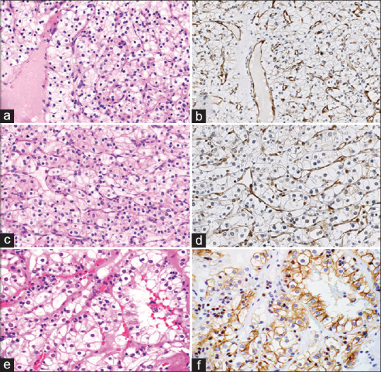 EphrinB2: Expression of a novel potential target in renal cell carcinoma.