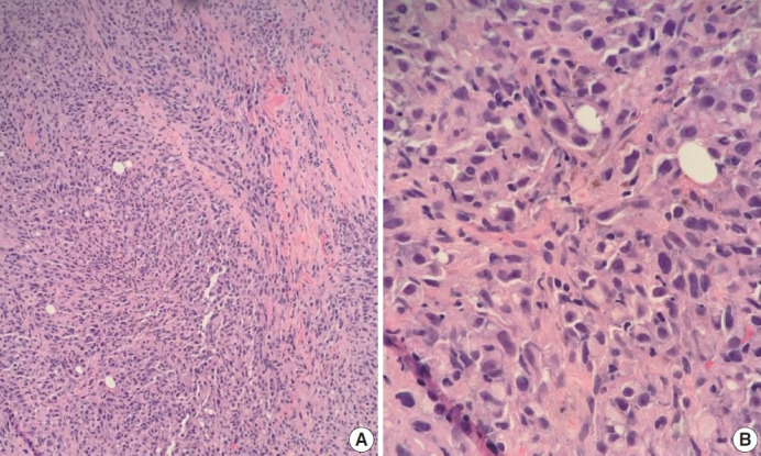 Metastatic choroidal melanoma in the breast: a case report and review of the literature.