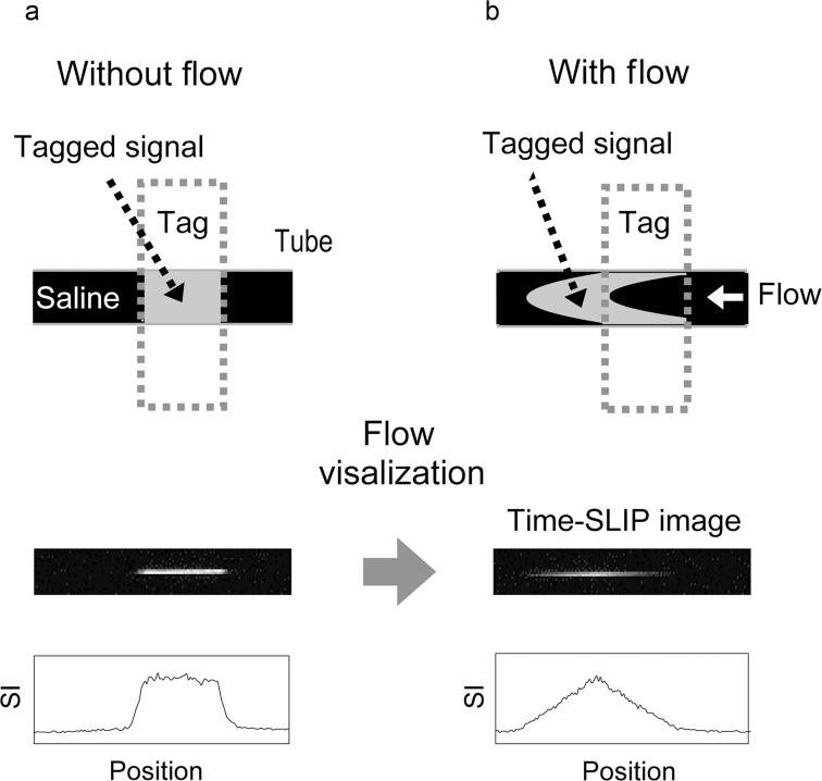 Using Spin-labeled MR Imaging to Depict Slow Pancreatic Juice Flow.