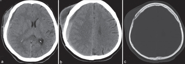 Tuberculous subdural empyema mimicking chronic subdural hematoma.