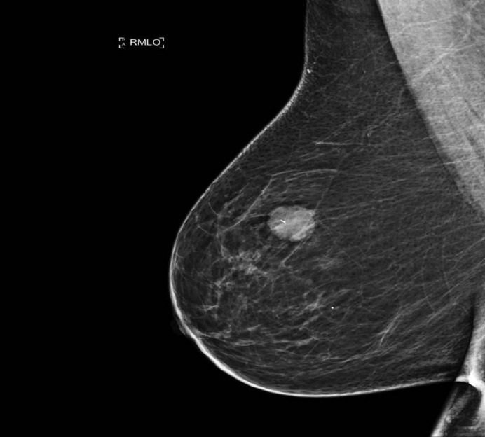 Metastatic choroidal melanoma in the breast: a case report and review of the literature.