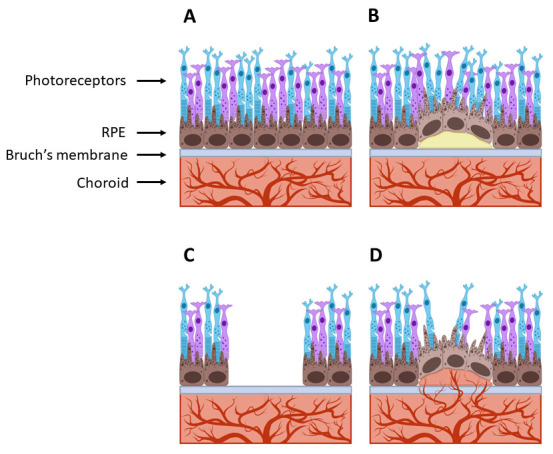 The impact of early RPE cell junction loss on VEGF, Ang-2, and TIMP secretion in vitro.