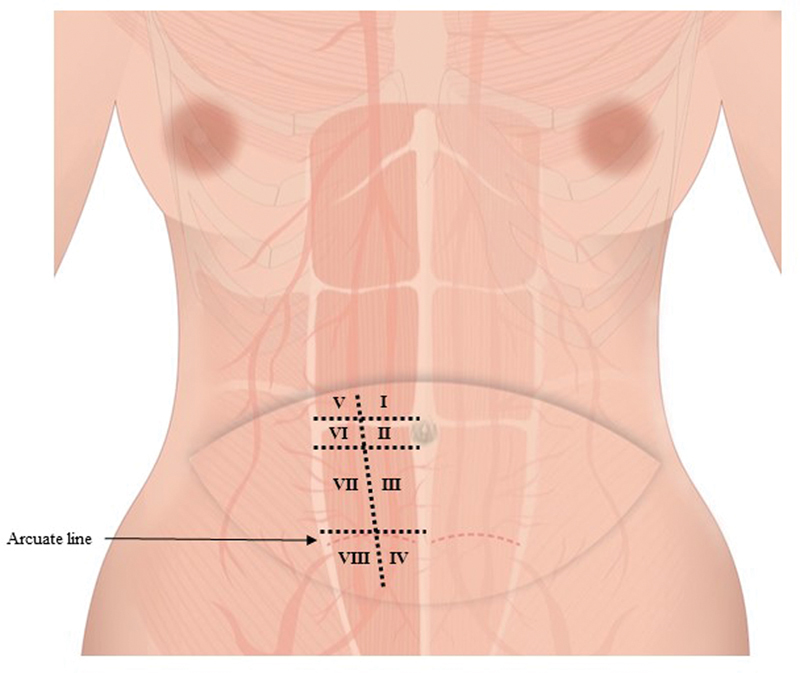 Deep Inferior Epigastric Perforators Topography for "Island Transverse Rectus Abdominis Musculocutaneous Flap" in Breast Reconstruction.