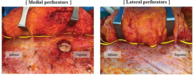 Deep Inferior Epigastric Perforators Topography for "Island Transverse Rectus Abdominis Musculocutaneous Flap" in Breast Reconstruction.