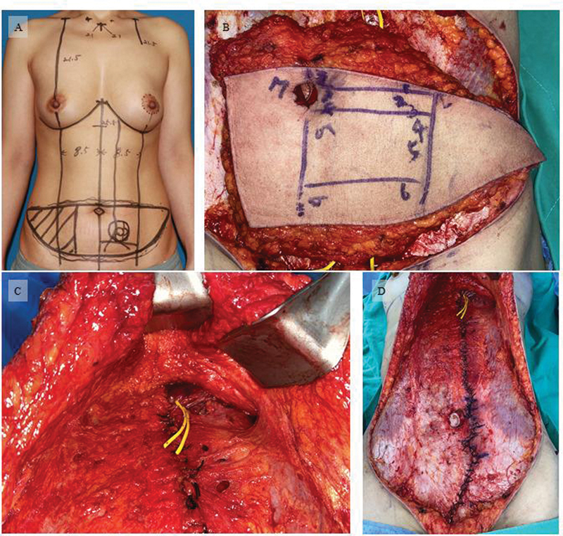 Deep Inferior Epigastric Perforators Topography for "Island Transverse Rectus Abdominis Musculocutaneous Flap" in Breast Reconstruction.