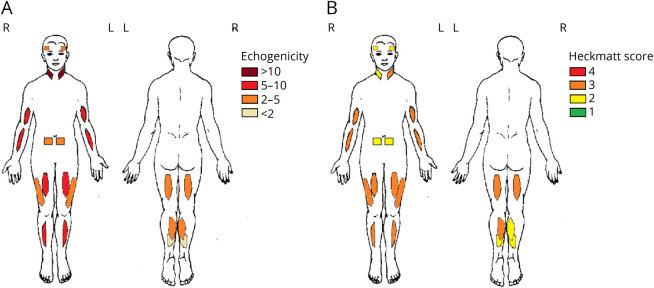 <i>LAMA2</i>-Related Muscular Dystrophy Across the Life Span: A Cross-sectional Study.