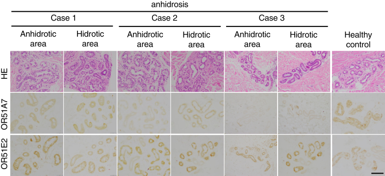 Transcriptome Profiling of Anhidrotic Eccrine Sweat Glands Reveals that Olfactory Receptors on Eccrine Sweat Glands Regulate Perspiration in a Ligand-Dependent Manner