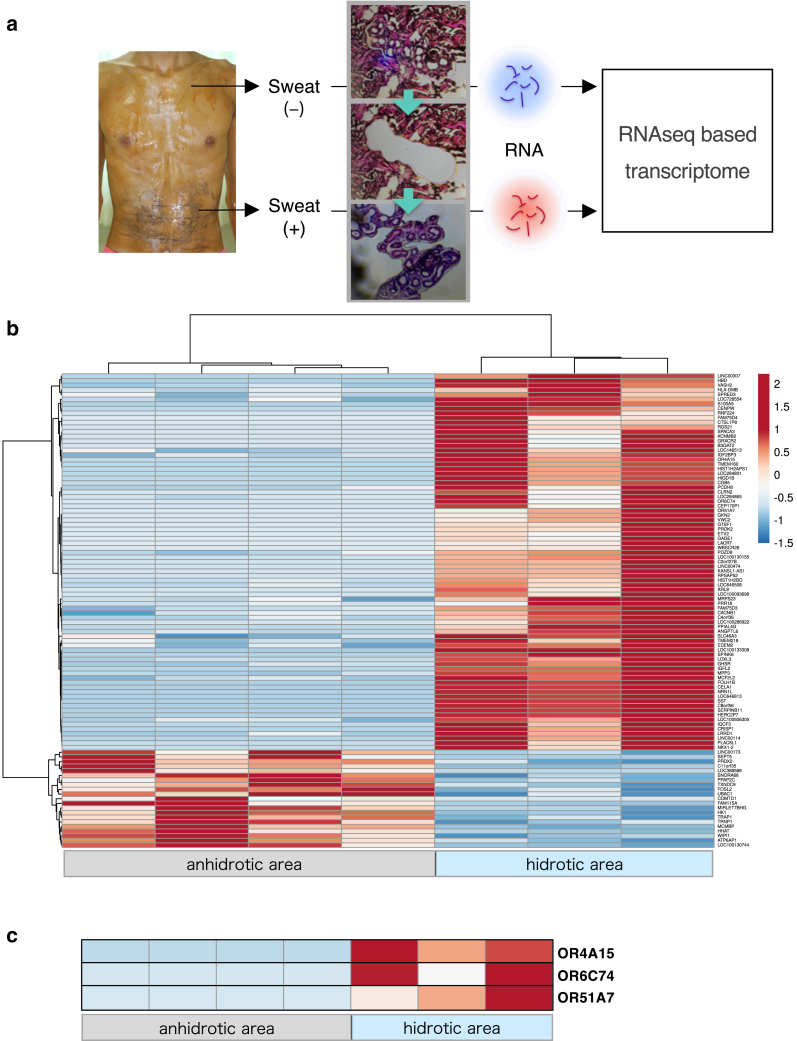 Transcriptome Profiling of Anhidrotic Eccrine Sweat Glands Reveals that Olfactory Receptors on Eccrine Sweat Glands Regulate Perspiration in a Ligand-Dependent Manner