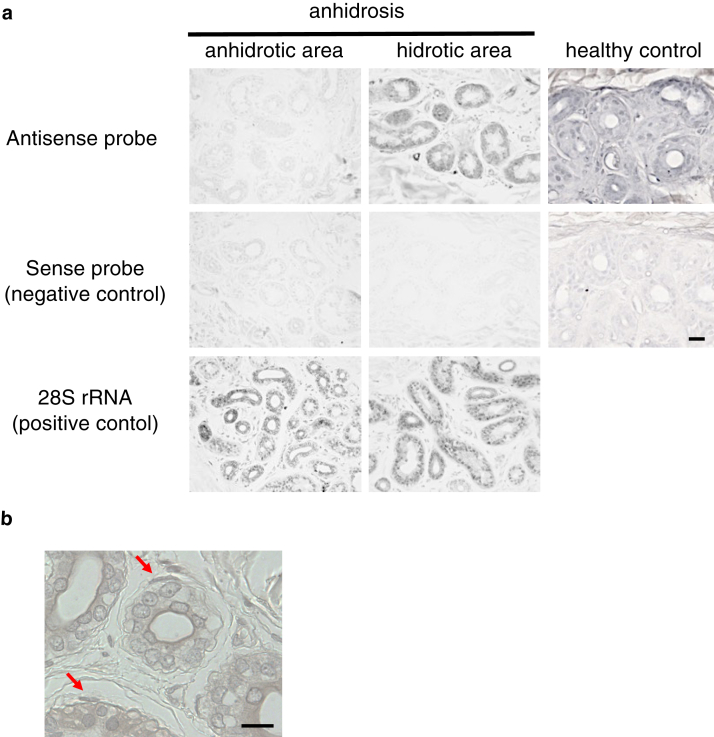 Transcriptome Profiling of Anhidrotic Eccrine Sweat Glands Reveals that Olfactory Receptors on Eccrine Sweat Glands Regulate Perspiration in a Ligand-Dependent Manner