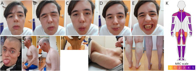 <i>LAMA2</i>-Related Muscular Dystrophy Across the Life Span: A Cross-sectional Study.