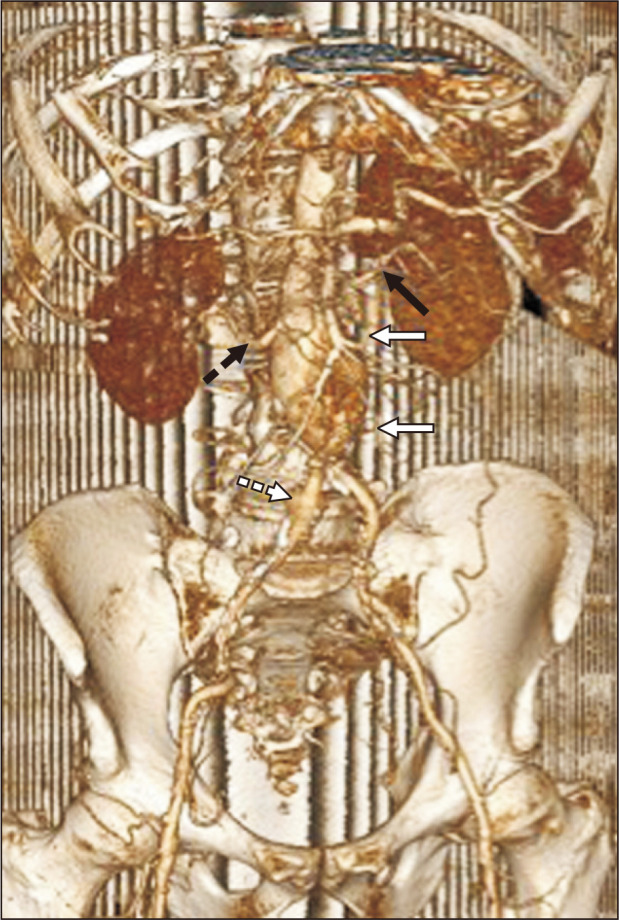 Surgical Considerations for the Management of an Ectopic Main Renal Artery Originating from an Abdominal Aortic Aneurysm.