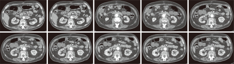 Surgical Considerations for the Management of an Ectopic Main Renal Artery Originating from an Abdominal Aortic Aneurysm.