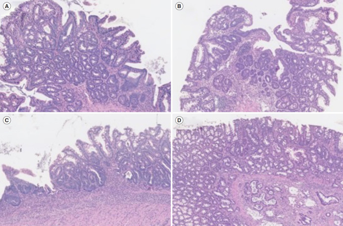 Does caffeine have a double-edged sword role in inflammation and carcinogenesis in the colon?