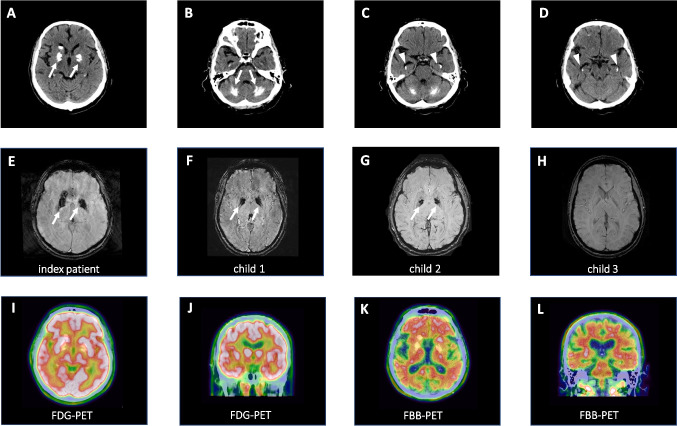 PSEN1/SLC20A2 double mutation causes early-onset Alzheimer's disease and primary familial brain calcification co-morbidity.